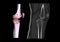 Compare of CT knee joint 3D rendering image lateral view and CT knee 2D Sagittal view isolated on black background showing