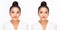 Compare faces before and after when beauty woman get Cosmetic surgery and Plastic surgery Asian girl has V shape face and has