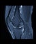 Compare of MRI knee or Magnetic resonance imaging of knee joint stir technique of axial, sagittal and coronal view for fat