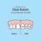 Compare upper teeth Clear braces before and after illustration vector on blue background. Dental concept