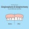 Compare upper teeth Gingivoplasty & Gingivectomy surgery before and after electrosurgery cut gum off illustration vector on blue