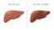 The Comparison between Healthy liver and Cirrhosis.