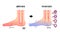 Comparison illustration of normal foot and cold foot  sensitivity to cold, cold toes / Japanese