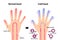 Comparison illustration of normal hand and cold hand  sensitivity to cold, cold fingertips