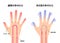 Comparison illustration of normal hand and cold hand  sensitivity to cold, cold fingertips / Japanese