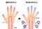 Comparison illustration of normal hand and cold hand  sensitivity to cold, cold fingertips / Japanese