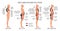 Comparison of muscle imbalance in various postural disorders. Kyphotic, lordotic, flat back posture infographics