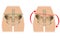 Comparison of pelvic distortion. Normal pelvis and distorted pelvis. Twisted Pelvis or Pelvic Torsion