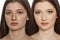 Comparison portrait of teenage girl with problematic skin, before and after skin treatment