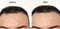 Comparison of  Before and after scar revision treatment  using laser , led  and creams on a man`s forehead face