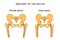 Comparison of the skeleton of the male and female pelvis