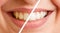 Comparison of teeth before and after tooth cleaning