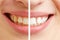 Before and after comparison of teeth whitening