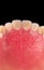 Complete maxillary denture â€“ Wax-Up and Gingival Contouring