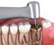 Complex tooth extraction. Medically accurate 3D illustration of dental treatment