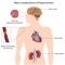 Complications of hypertension