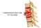 Compression fracture of the spine