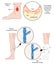 Compression therapy for leg ulcers