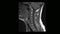 Computed medical tomography MRI scan of the cervical spine of a man with osteochondrosis