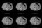 Computed tomography CT whole abdomen in Axial. Part fifteen