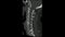 Computed Tomography examination of the  Cervical spine  CT CS