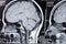 Computer axial tomography scan (CAT) of a head