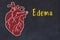 Concept of learning cardiovascular system. Chalk drawing of human heart and inscription Edema