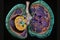 Concept urolithiasis disease. Abstract Kidney model with stones. Generation AI