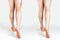 The concept of varicose veins and cosmetic treatment. A caucasian woman massages her legs with and without vascular stars.Rear