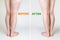 The concept of varicose veins and cosmetic treatment. Female legs with with and without vascular asterisks. Rear view. White
