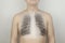 Conceptual photo. Male chest x-ray. An image of the ribs and lungs appeared on the skin of the patient back. View of bones through