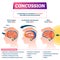 Concussion vector illustration. Labeled educational post head trauma scheme