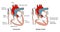 Congenital heart defect