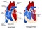 Congenital heart disease: Tetralogy of Fallot