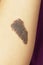 Congenital melanocytic naevi birthmark on a woman`s arm