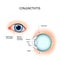 Conjunctivitis. External View and Vertical section of the human