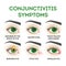 Conjunctivitis symptoms. Pink eye disease, infection and allergy