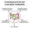 Consequences of intestinal dysbiosis. Dysbacteriosis of the colon Infographics