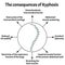 The consequences of kyphosis. Spinal curvature, kyphosis, lordosis, scoliosis, arthrosis. Improper posture and stoop