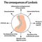 The consequences of lordosis. Spinal curvature, kyphosis, lordosis, scoliosis, arthrosis. Improper posture and stoop