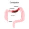 Constipation. Vector diagram represent the human large intestine with fecal matter and bowel gas bubbles