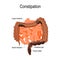 Constipation. Vector illustration