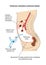 Continuous ambulatory peritoneal dialysis