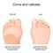 Corns on toe and calluses on sole