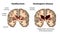 Coronal sections of a healthy brain and a brain in Huntington's disease