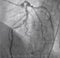 Coronary angiogram , medical x-ray