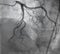 Coronary angiography. left coronary angiography.