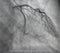 Coronary angiography. left coronary angiography.