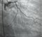 Coronary angiography. x-ray image.