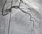 Coronary angiography. x-ray image.